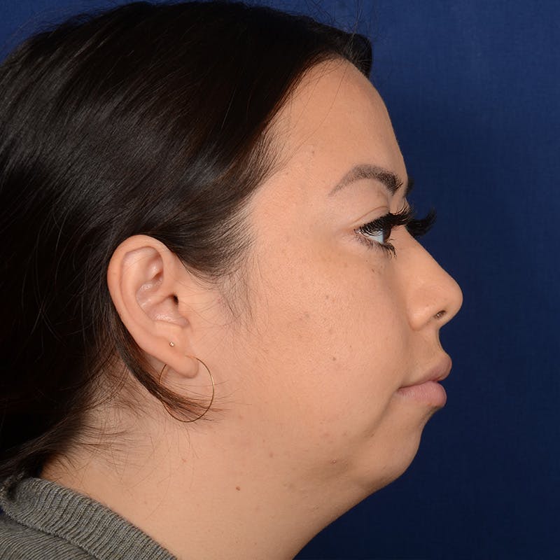 Rhinoplasty w/ Chin Implant Before & After Gallery - Patient 321116 - Image 5