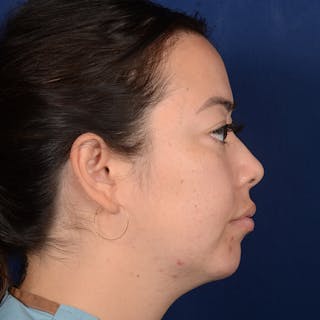 Rhinoplasty w/ Chin Implant Before & After Gallery - Patient 321116 - Image 6