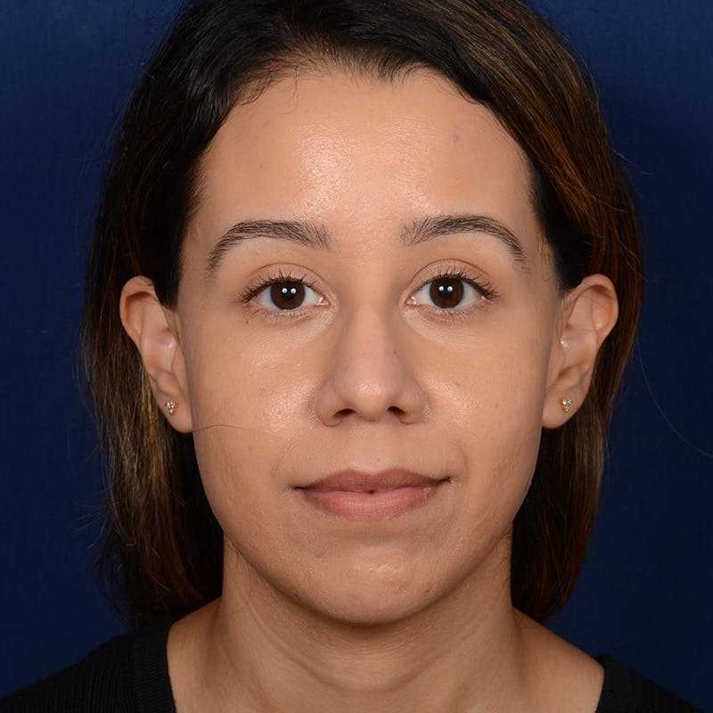 Rhinoplasty w/ Chin Implant Before & After Gallery - Patient 269225 - Image 1