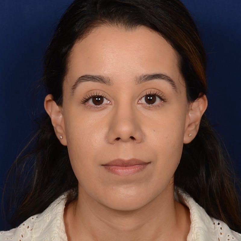 Rhinoplasty w/ Chin Implant Before & After Gallery - Patient 269225 - Image 2