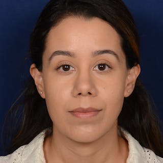 Rhinoplasty w/ Chin Implant Before & After Gallery - Patient 269225 - Image 2