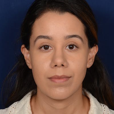 Rhinoplasty w/ Chin Implant Before & After Gallery - Patient 269225 - Image 2