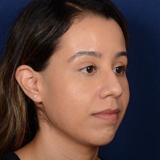 Rhinoplasty w/ Chin Implant Before & After Gallery - Patient 269225 - Image 4