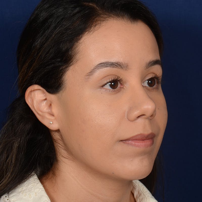 Rhinoplasty w/ Chin Implant Before & After Gallery - Patient 269225 - Image 3