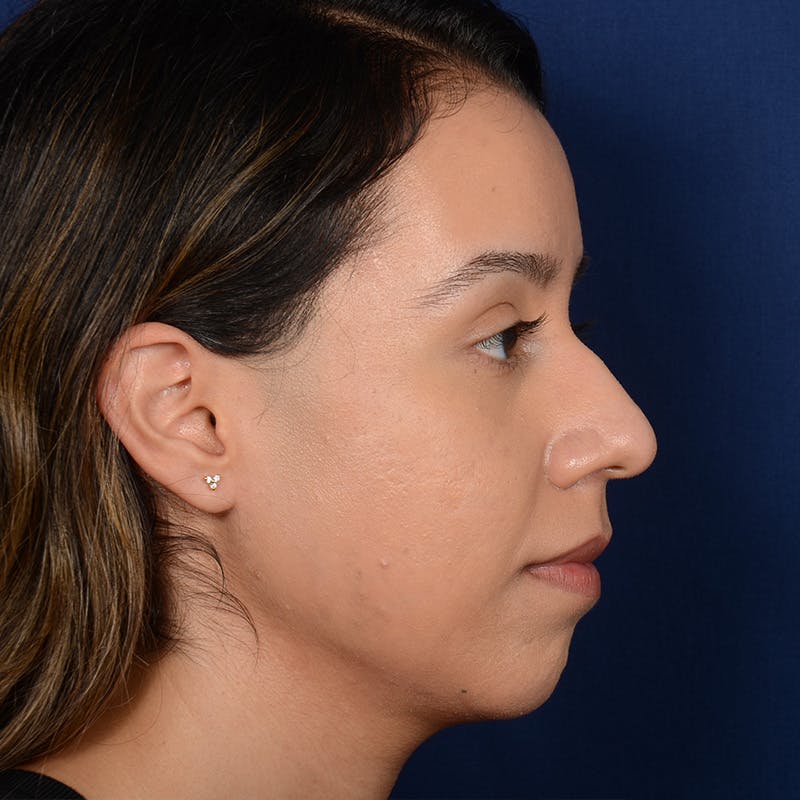 Rhinoplasty w/ Chin Implant Before & After Gallery - Patient 269225 - Image 5