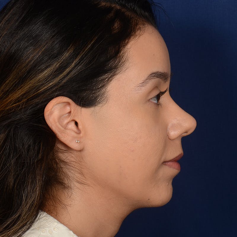 Rhinoplasty w/ Chin Implant Before & After Gallery - Patient 269225 - Image 6