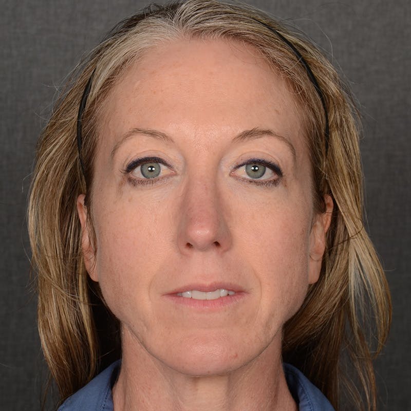 Rhinoplasty w/ Chin Implant Before & After Gallery - Patient 177608 - Image 2