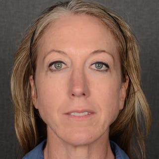 Rhinoplasty w/ Chin Implant Before & After Gallery - Patient 177608 - Image 2