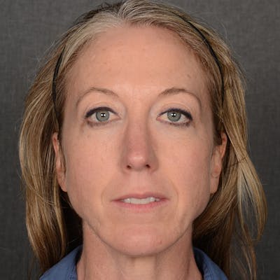 Rhinoplasty w/ Chin Implant Before & After Gallery - Patient 177608 - Image 2