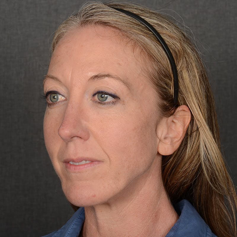 Rhinoplasty w/ Chin Implant Before & After Gallery - Patient 177608 - Image 4
