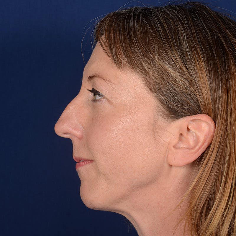 Rhinoplasty w/ Chin Implant Before & After Gallery - Patient 177608 - Image 5