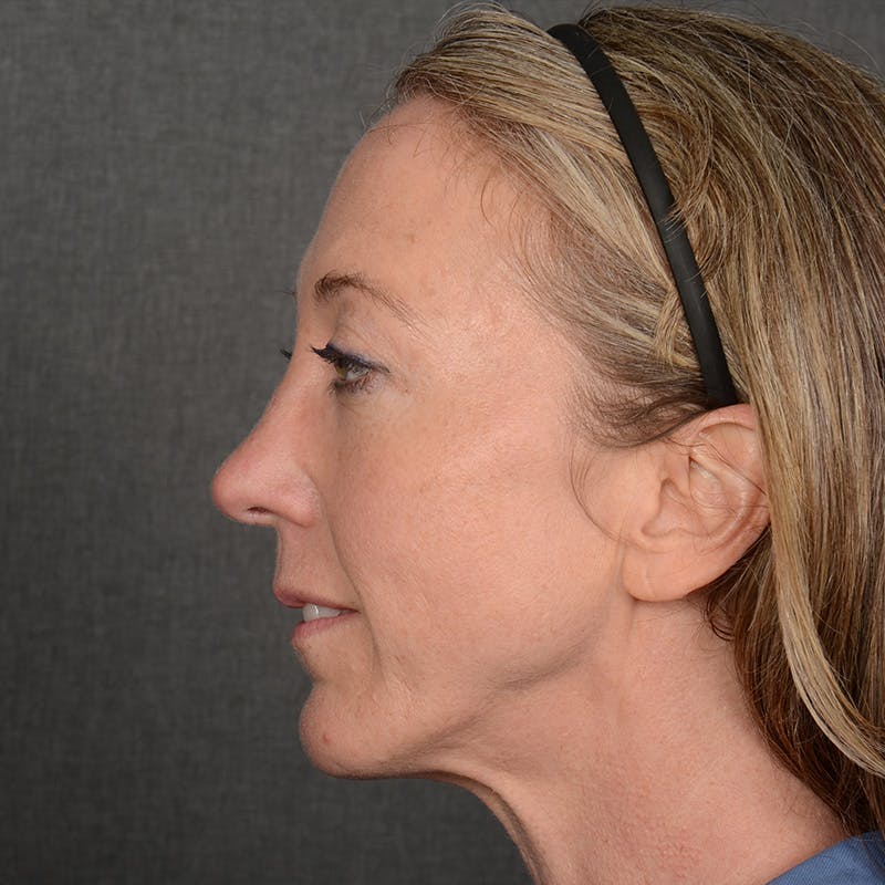 Rhinoplasty w/ Chin Implant Before & After Gallery - Patient 177608 - Image 6