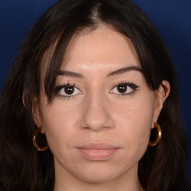 Rhinoplasty w/ Chin Implant Before & After Gallery - Patient 152907 - Image 1