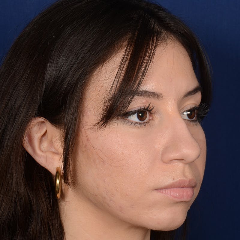 Rhinoplasty w/ Chin Implant Before & After Gallery - Patient 152907 - Image 3