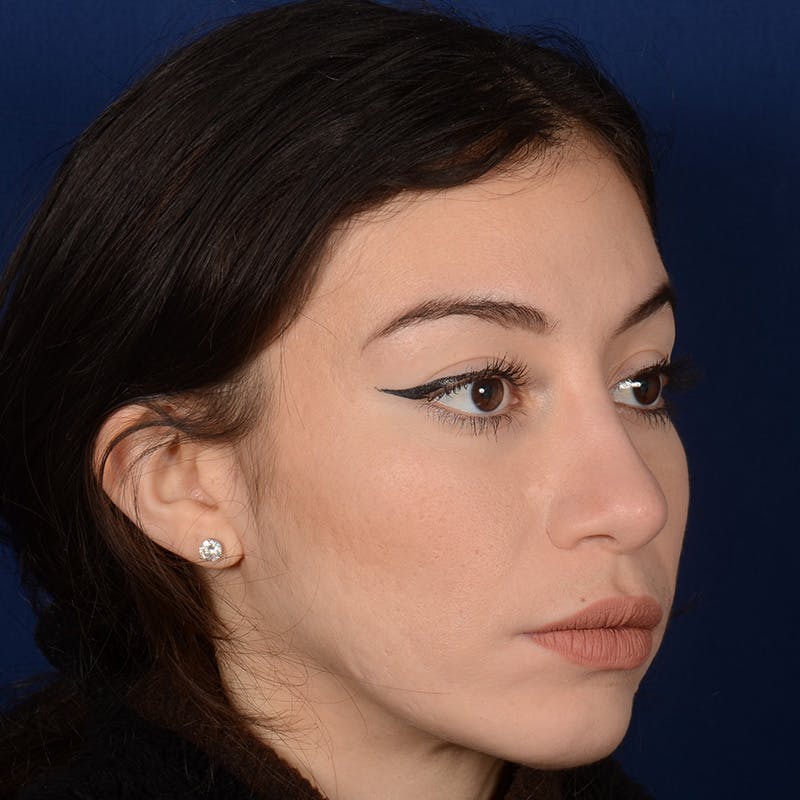 Rhinoplasty w/ Chin Implant Before & After Gallery - Patient 152907 - Image 4