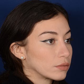 Rhinoplasty w/ Chin Implant Before & After Gallery - Patient 152907 - Image 4