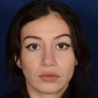 Rhinoplasty w/ Chin Implant Before & After Gallery - Patient 152907 - Image 2