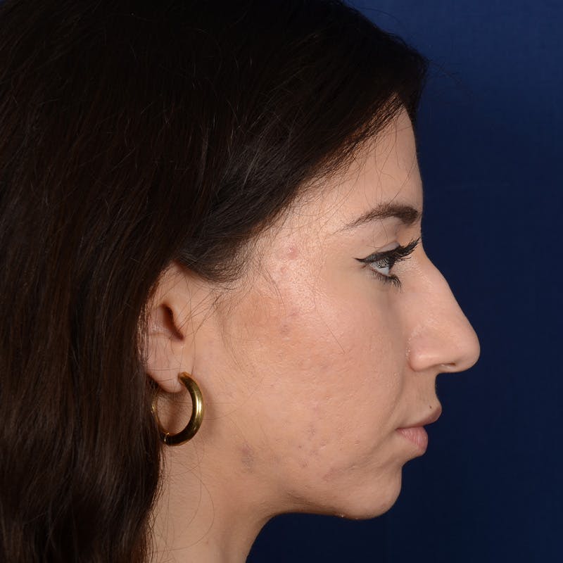 Rhinoplasty w/ Chin Implant Before & After Gallery - Patient 152907 - Image 5