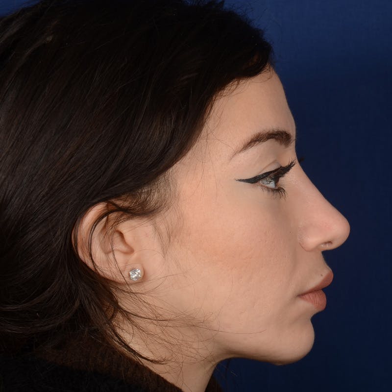 Rhinoplasty w/ Chin Implant Before & After Gallery - Patient 152907 - Image 6