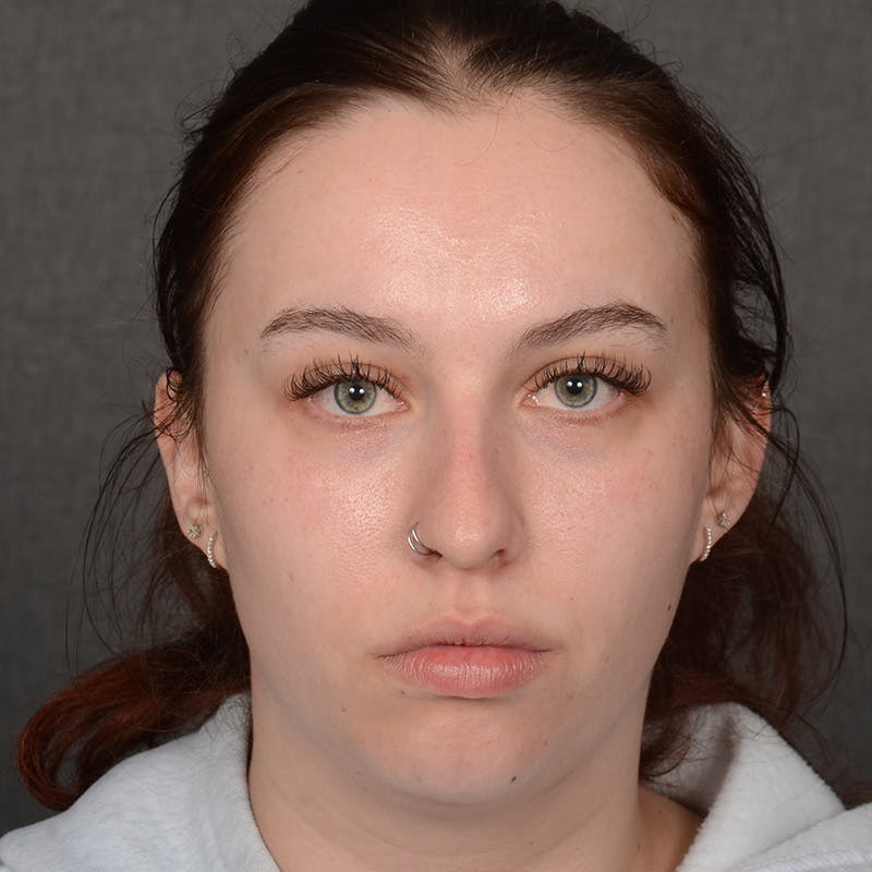 Rhinoplasty w/ Chin Implant Before & After Gallery - Patient 352436 - Image 1