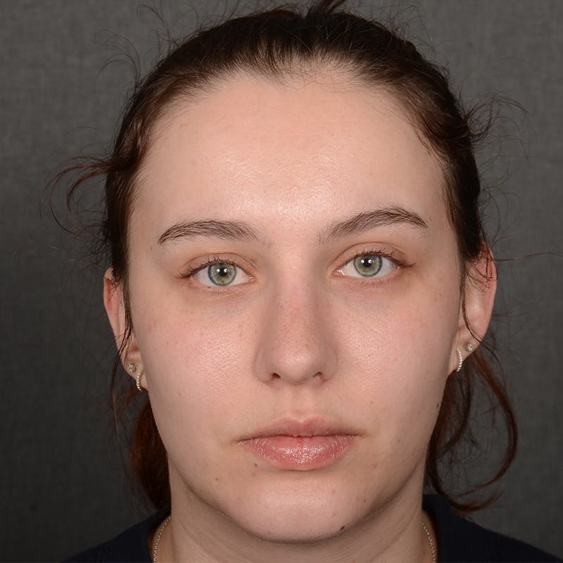 Rhinoplasty w/ Chin Implant Before & After Gallery - Patient 352436 - Image 2