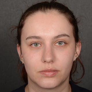 Rhinoplasty w/ Chin Implant Before & After Gallery - Patient 352436 - Image 2