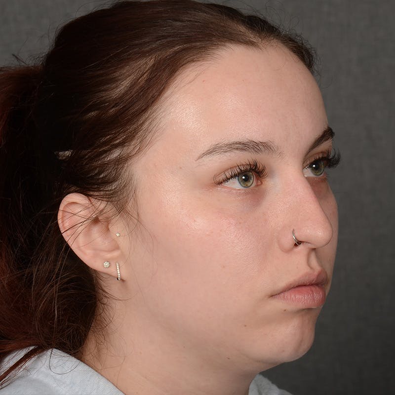 Rhinoplasty w/ Chin Implant Before & After Gallery - Patient 352436 - Image 3