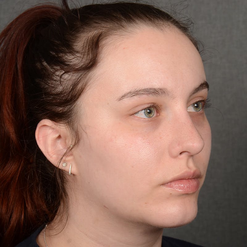 Rhinoplasty w/ Chin Implant Before & After Gallery - Patient 352436 - Image 4