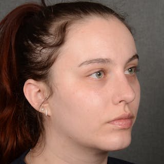 Rhinoplasty w/ Chin Implant Before & After Gallery - Patient 352436 - Image 4