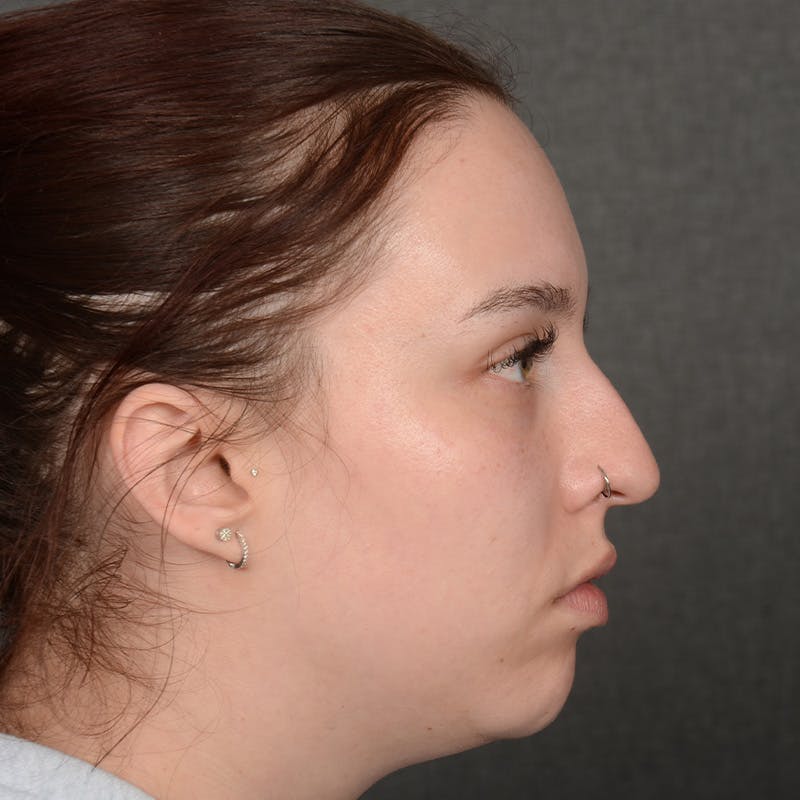 Rhinoplasty w/ Chin Implant Before & After Gallery - Patient 352436 - Image 5