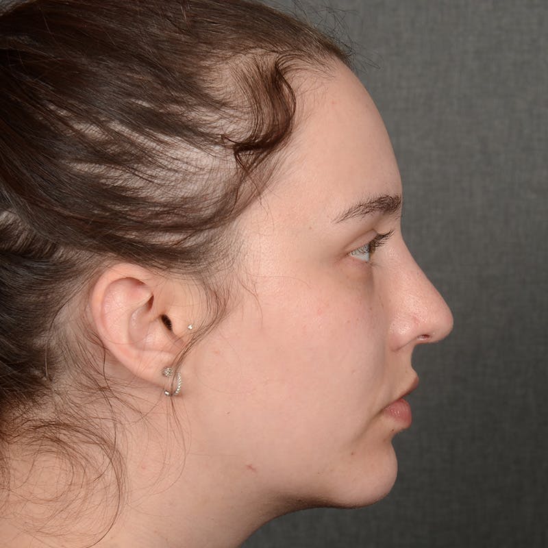Rhinoplasty w/ Chin Implant Before & After Gallery - Patient 352436 - Image 6