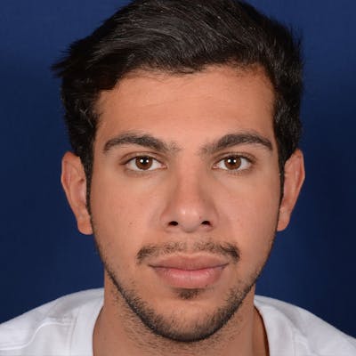 Rhinoplasty w/ Chin Implant Before & After Gallery - Patient 402544 - Image 2