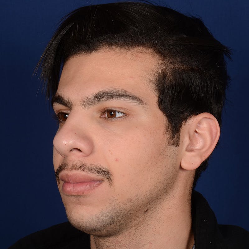 Rhinoplasty w/ Chin Implant Before & After Gallery - Patient 402544 - Image 3