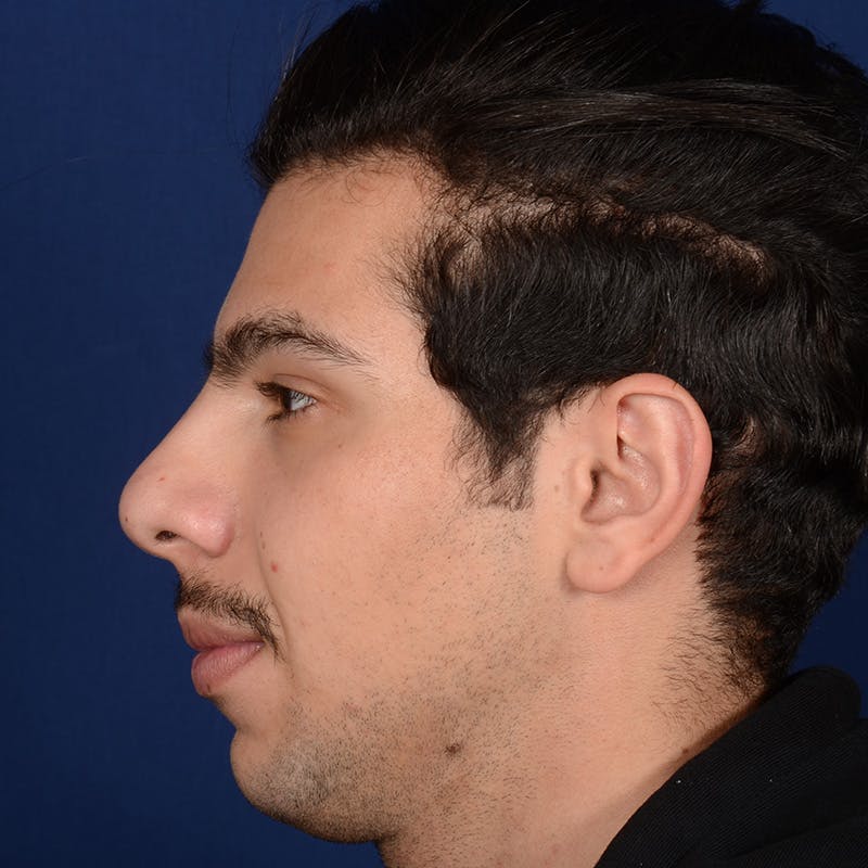 Rhinoplasty w/ Chin Implant Before & After Gallery - Patient 402544 - Image 5