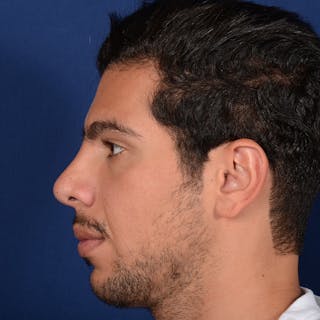 Rhinoplasty w/ Chin Implant Before & After Gallery - Patient 402544 - Image 6
