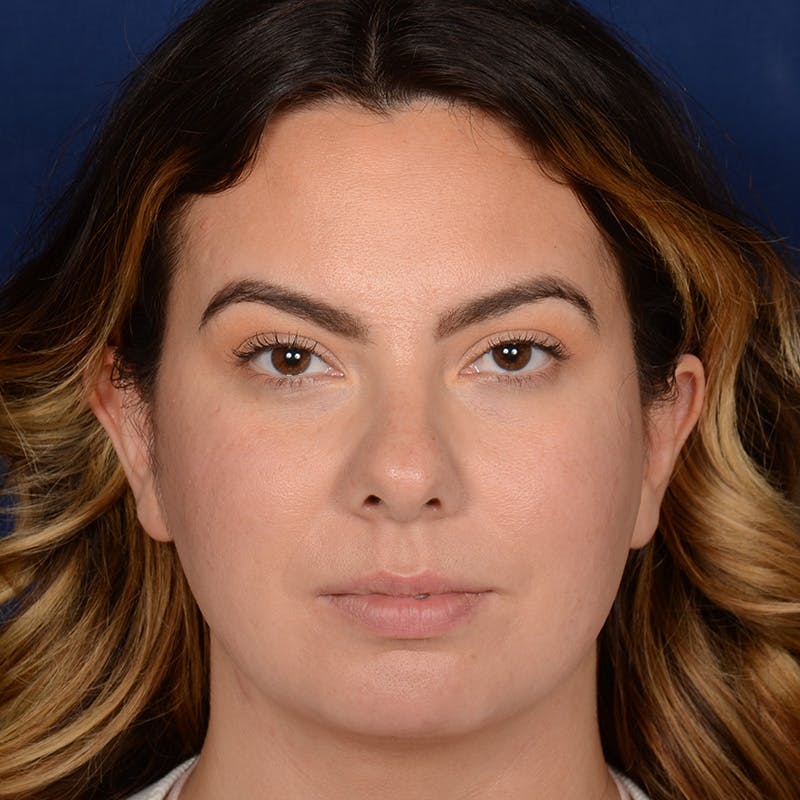 Rhinoplasty w/ Chin Implant Before & After Gallery - Patient 389185 - Image 1