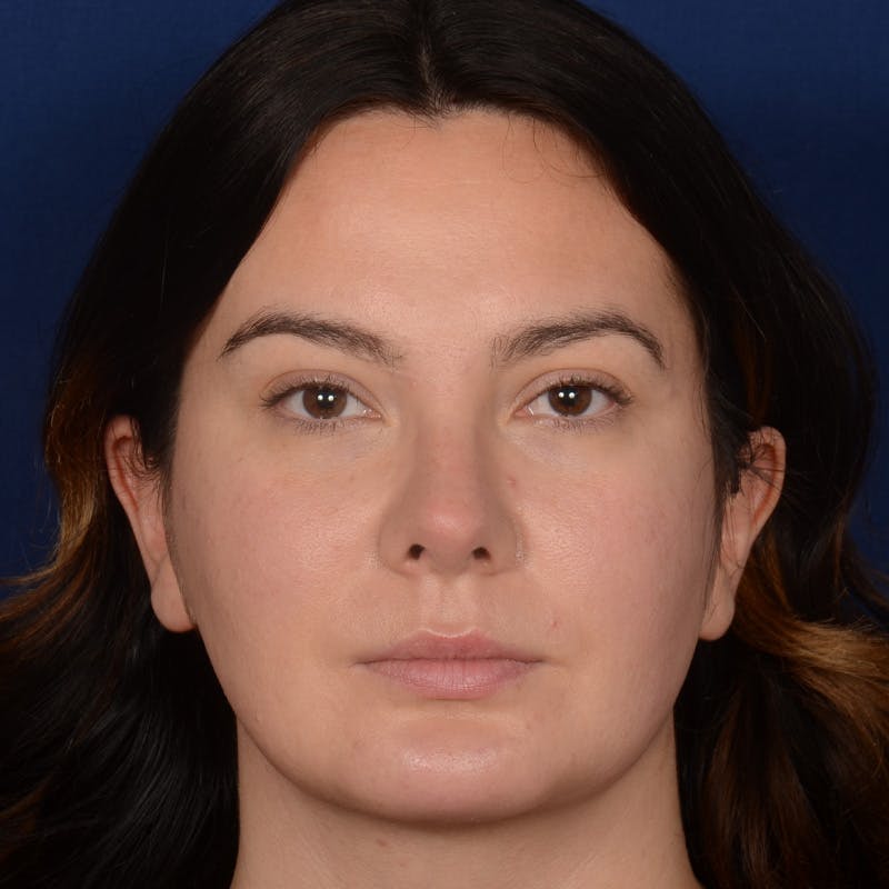 Rhinoplasty w/ Chin Implant Before & After Gallery - Patient 389185 - Image 2