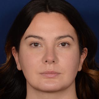 Rhinoplasty w/ Chin Implant Before & After Gallery - Patient 389185 - Image 2