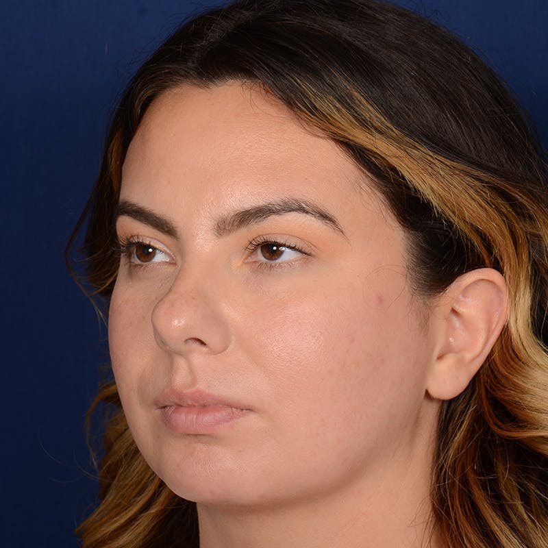 Rhinoplasty w/ Chin Implant Before & After Gallery - Patient 389185 - Image 3