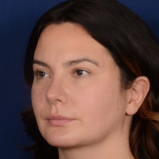 Rhinoplasty w/ Chin Implant Before & After Gallery - Patient 389185 - Image 4