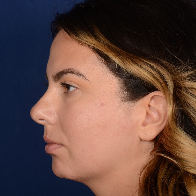 Rhinoplasty w/ Chin Implant Before & After Gallery - Patient 389185 - Image 5