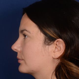 Rhinoplasty w/ Chin Implant Before & After Gallery - Patient 389185 - Image 6
