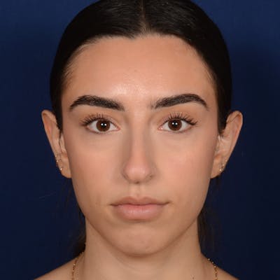 Rhinoplasty w/ Chin Implant Before & After Gallery - Patient 390620 - Image 1