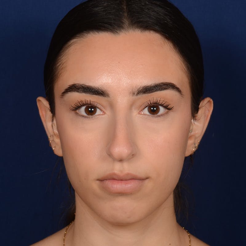 Rhinoplasty w/ Chin Implant Before & After Gallery - Patient 390620 - Image 1