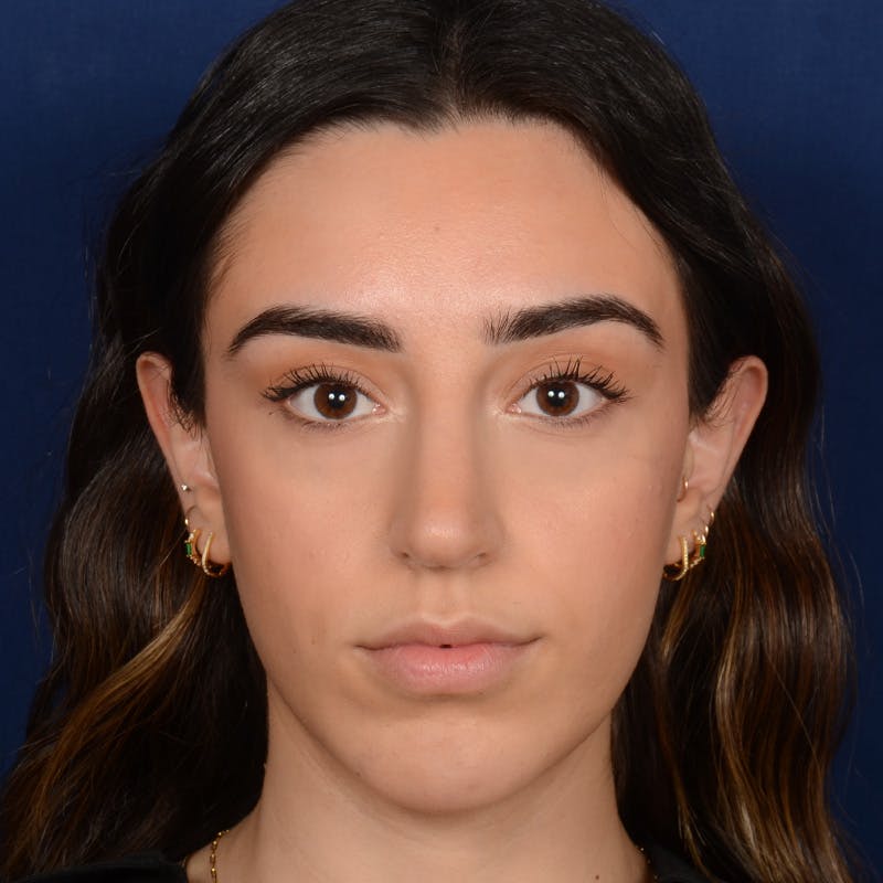 Rhinoplasty w/ Chin Implant Before & After Gallery - Patient 390620 - Image 2