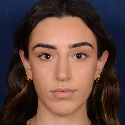 Rhinoplasty w/ Chin Implant Before & After Gallery - Patient 390620 - Image 2