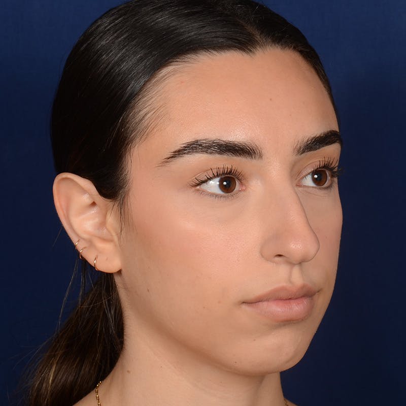 Rhinoplasty w/ Chin Implant Before & After Gallery - Patient 390620 - Image 3