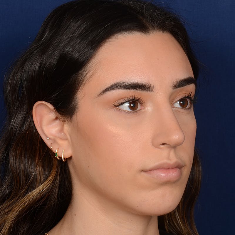 Rhinoplasty w/ Chin Implant Before & After Gallery - Patient 390620 - Image 4