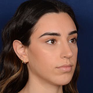 Rhinoplasty w/ Chin Implant Before & After Gallery - Patient 390620 - Image 4