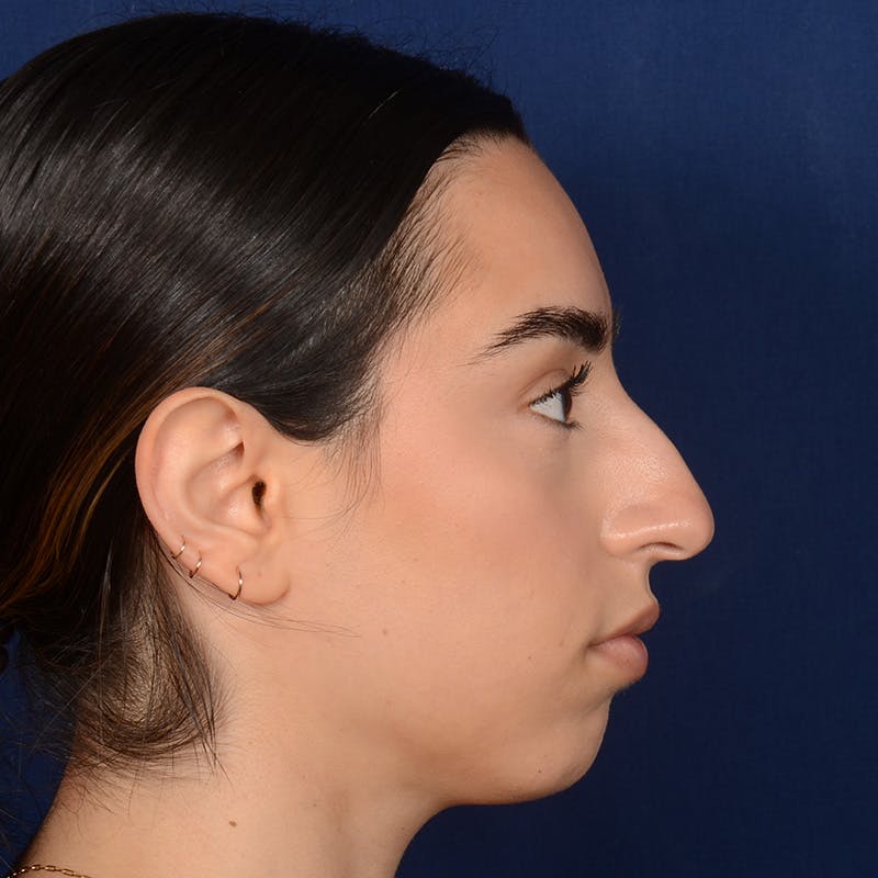 Rhinoplasty w/ Chin Implant Before & After Gallery - Patient 390620 - Image 5